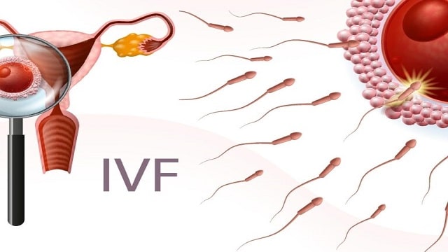 IVF Treatment