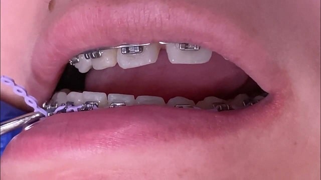 What Are Power Chains For Braces