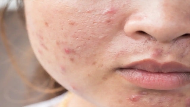 What is pregnancy Acne