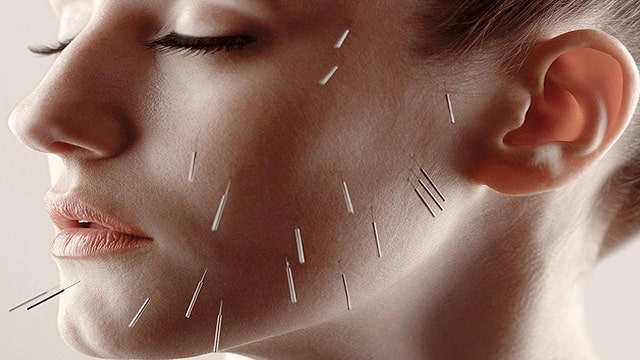 Cosmetic Acupuncture