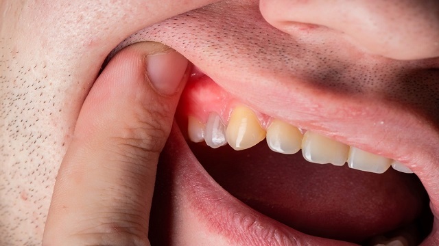 Dental Abscess