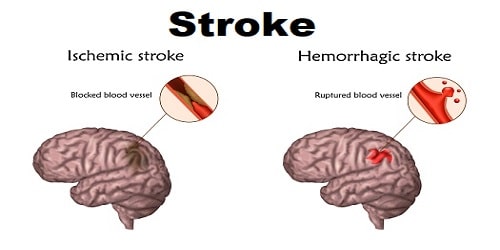 Stroke