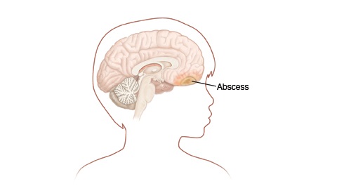 Brain Abscess