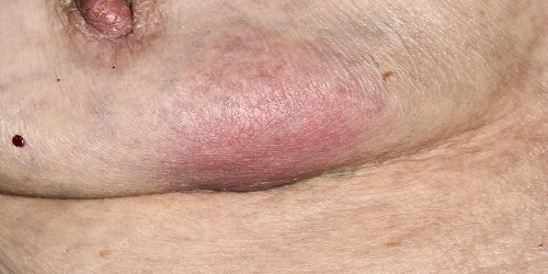 Breast Abscess