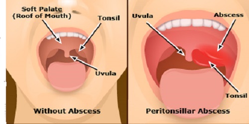 Peritonsillar Abscess