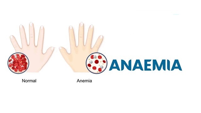 Anemia