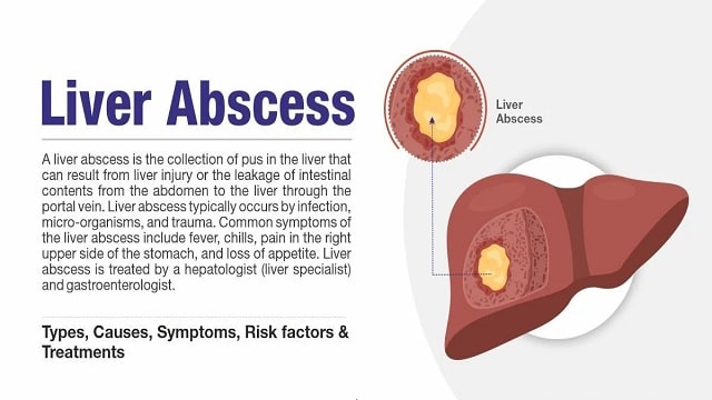 Liver Abscess