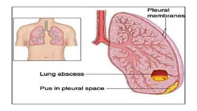 Lung Abscess