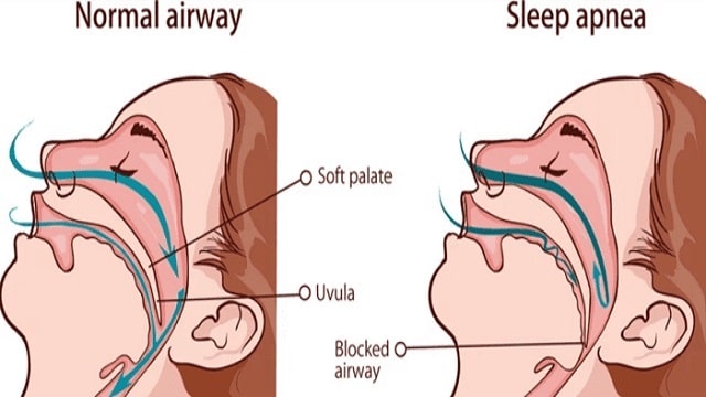 Sleep Apnea