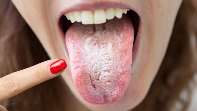 5 Causes Of A White Tongue