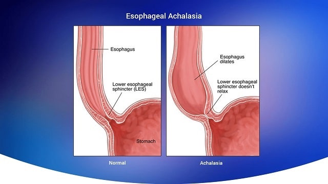 achalasia