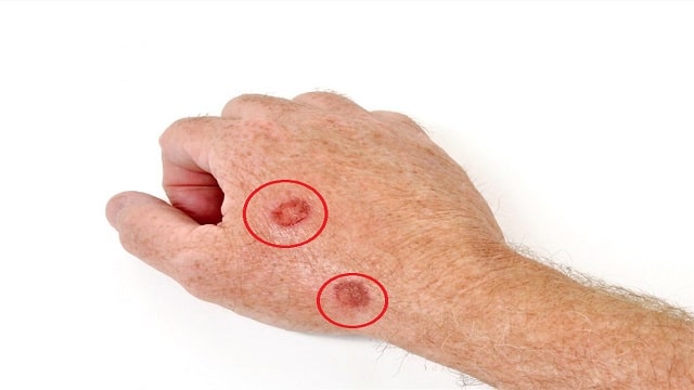 Actinic Keratosis