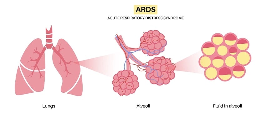 Acute Respiratory Distress Syndrome