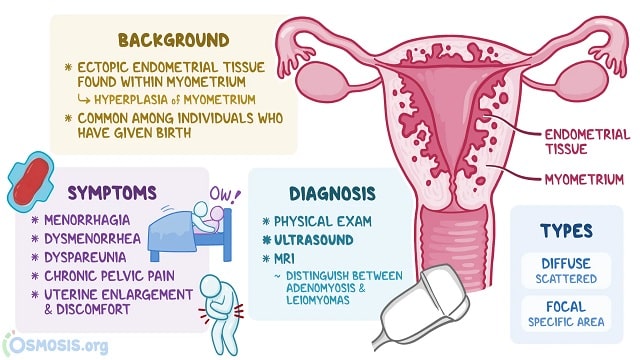 Adenomyosis