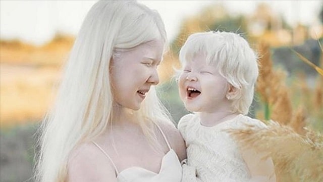 Albinism