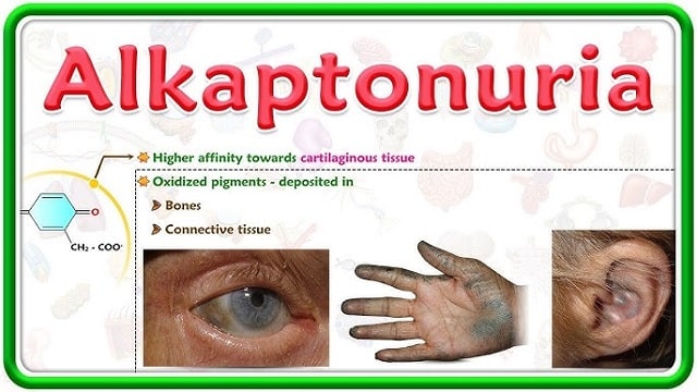 Alkaptonuria