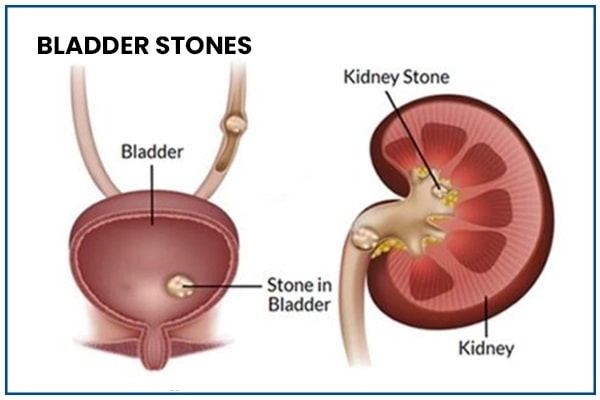 Bladder Stones