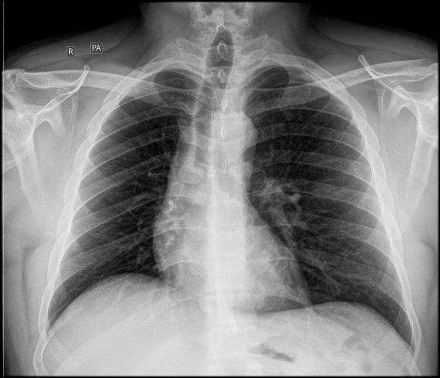 Bronchial Adenoma