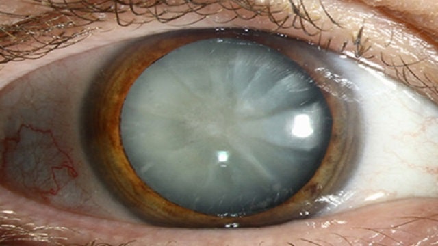 cataract