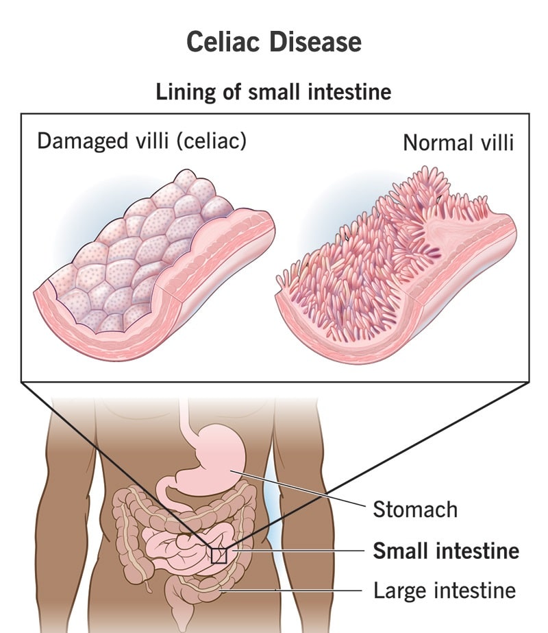 Celiac Disease