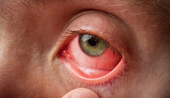 Conjunctivitis