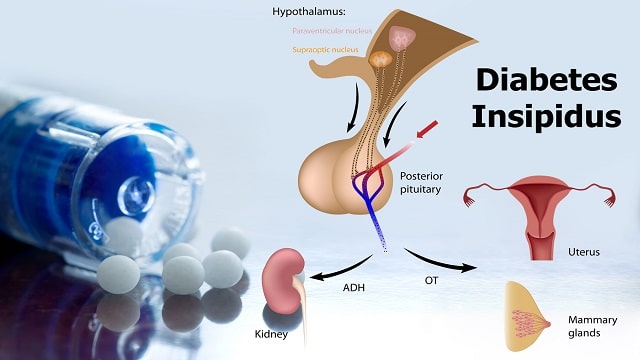 Diabetes Insipidus