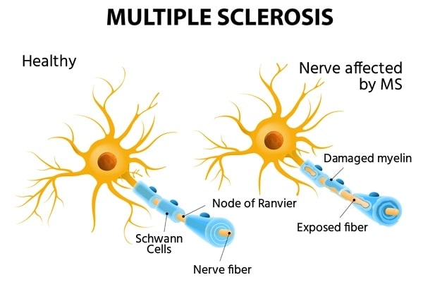 Multiple Sclerosis