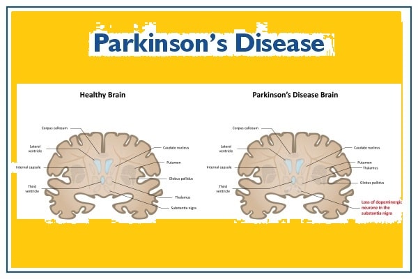 Parkinson's Disease