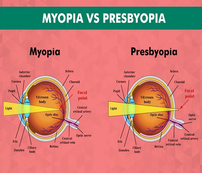 presbyopia