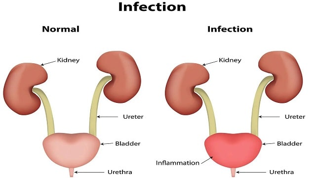 Urinary Tract Infection