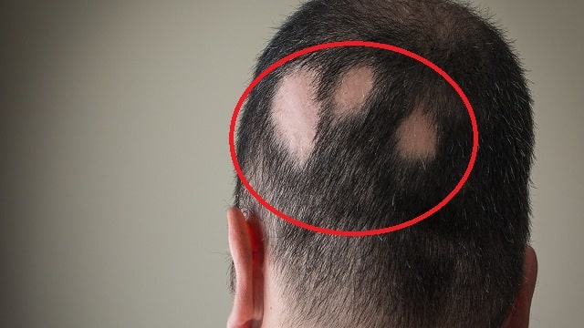 Alopecia Areata