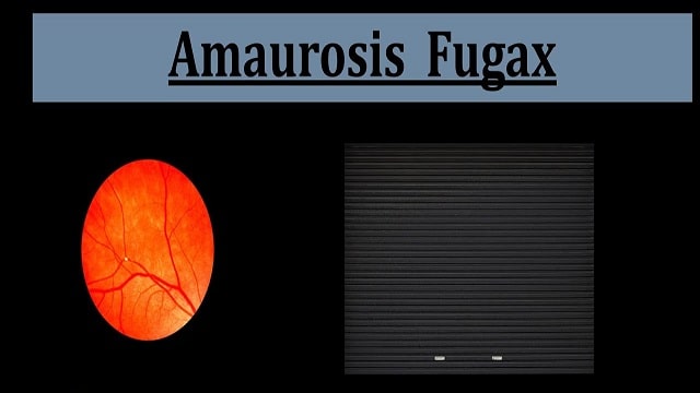 Amaurosis Fugax