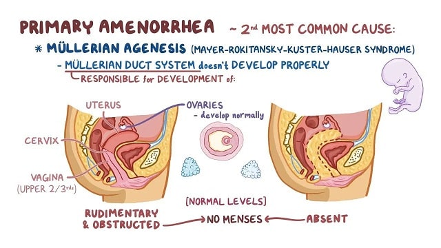 Amenorrhea