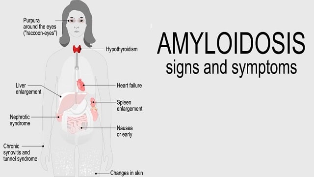 Amyloidosis