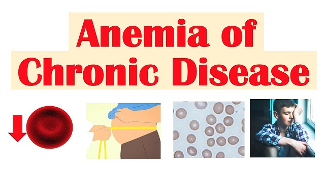 Anemia due to Chronic Disease