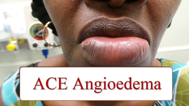 Angioedema