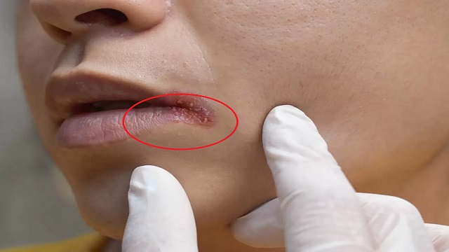 Angular Cheilitis