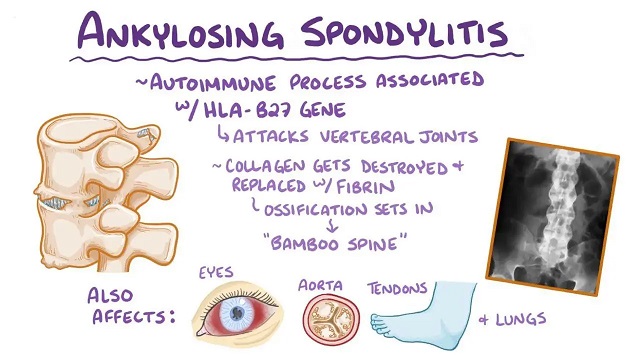 Ankylosing Spondylitis