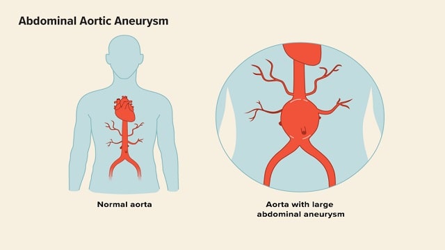 Aortic Aneurysm