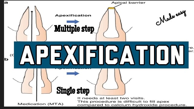 Apexification