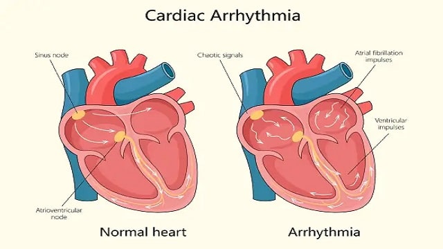 Arrhythmia