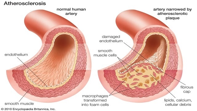 Arteriosclerosis