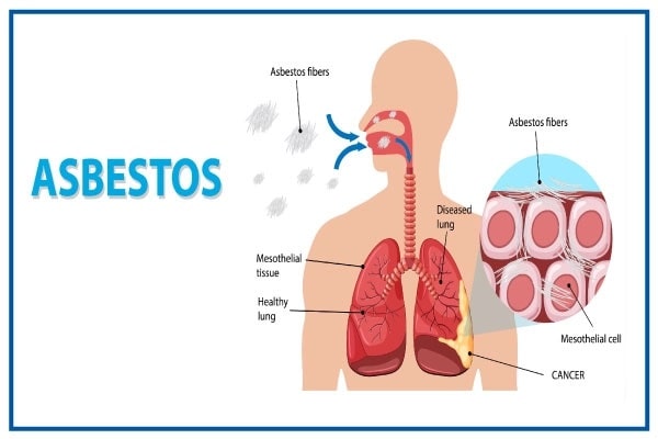 Asbestosis