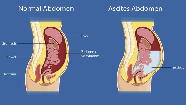 Ascites