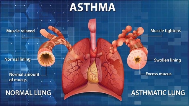 Asthma