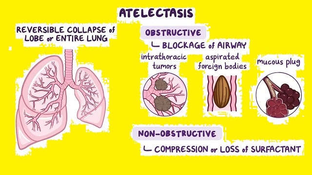 Atelectasis