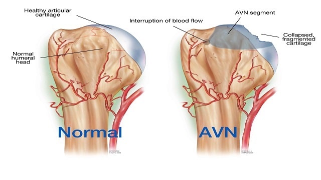 Avascular Necrosis