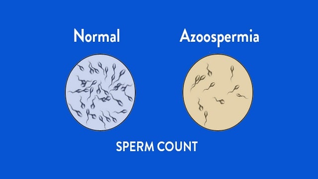 Azoospermia