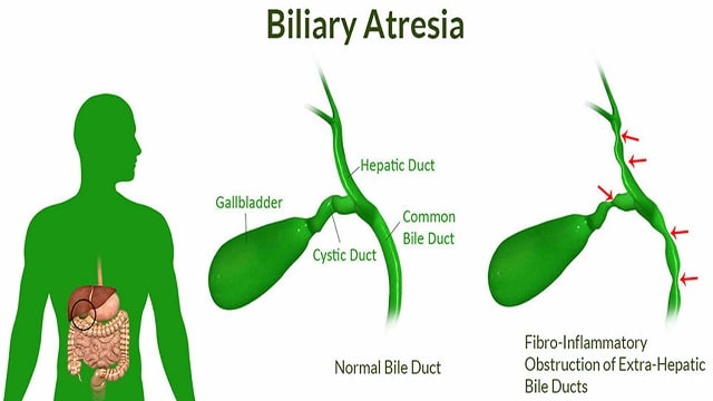 Biliary Atresia