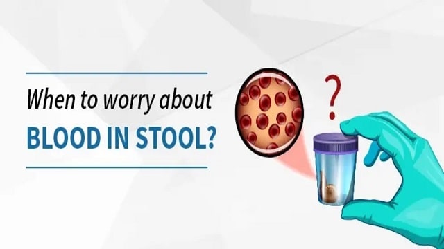 Bloody Stool